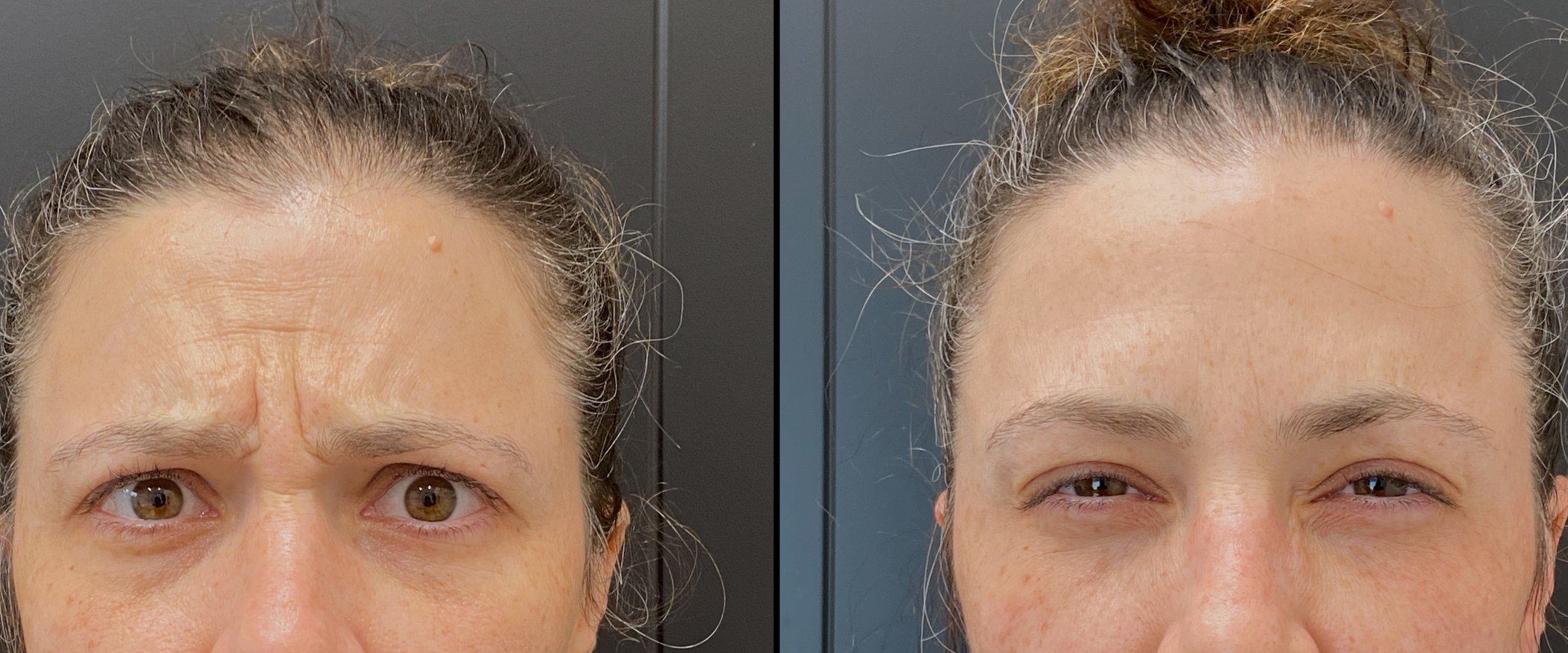 Botox/Dysport/Xeomin/Daxxify