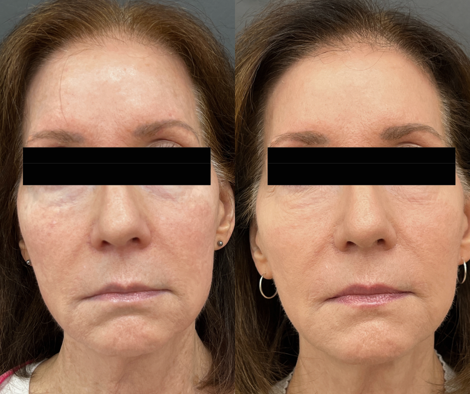 "Sprinkle Effect" RenewRX