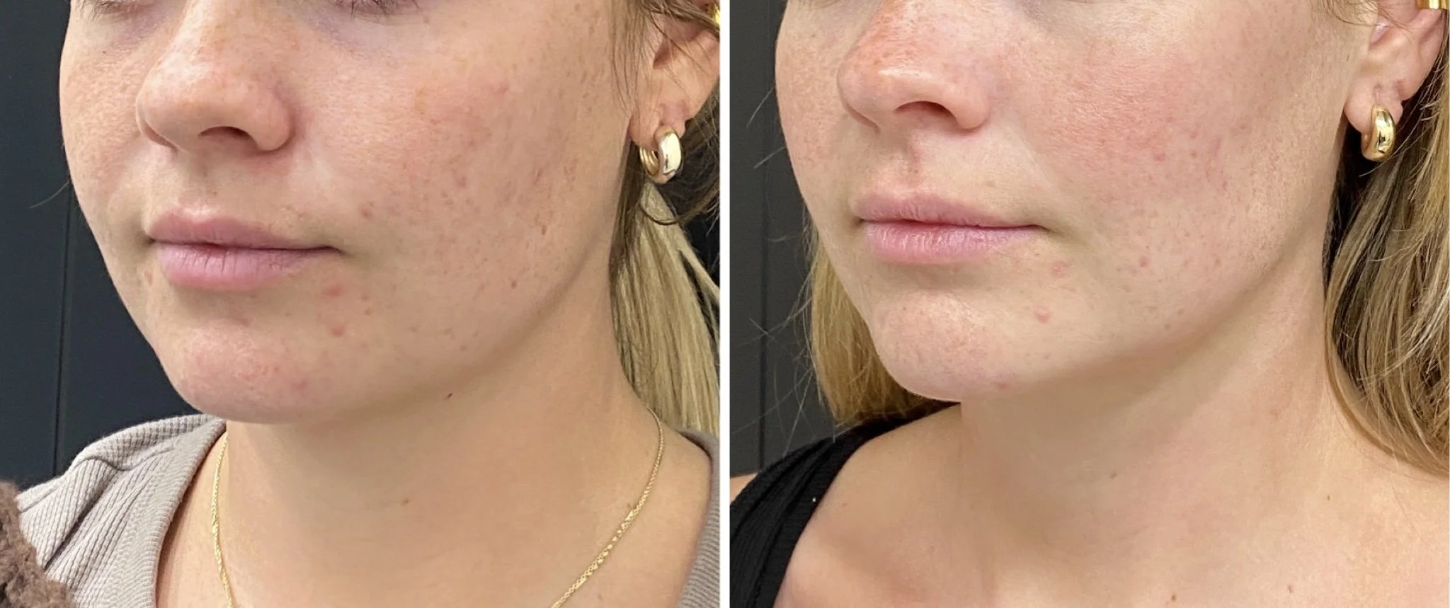 Chin/Jawline Filler