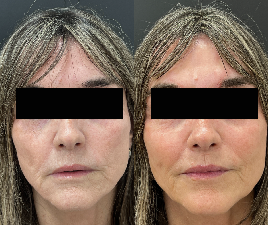 12 Weeks Post RenewRX