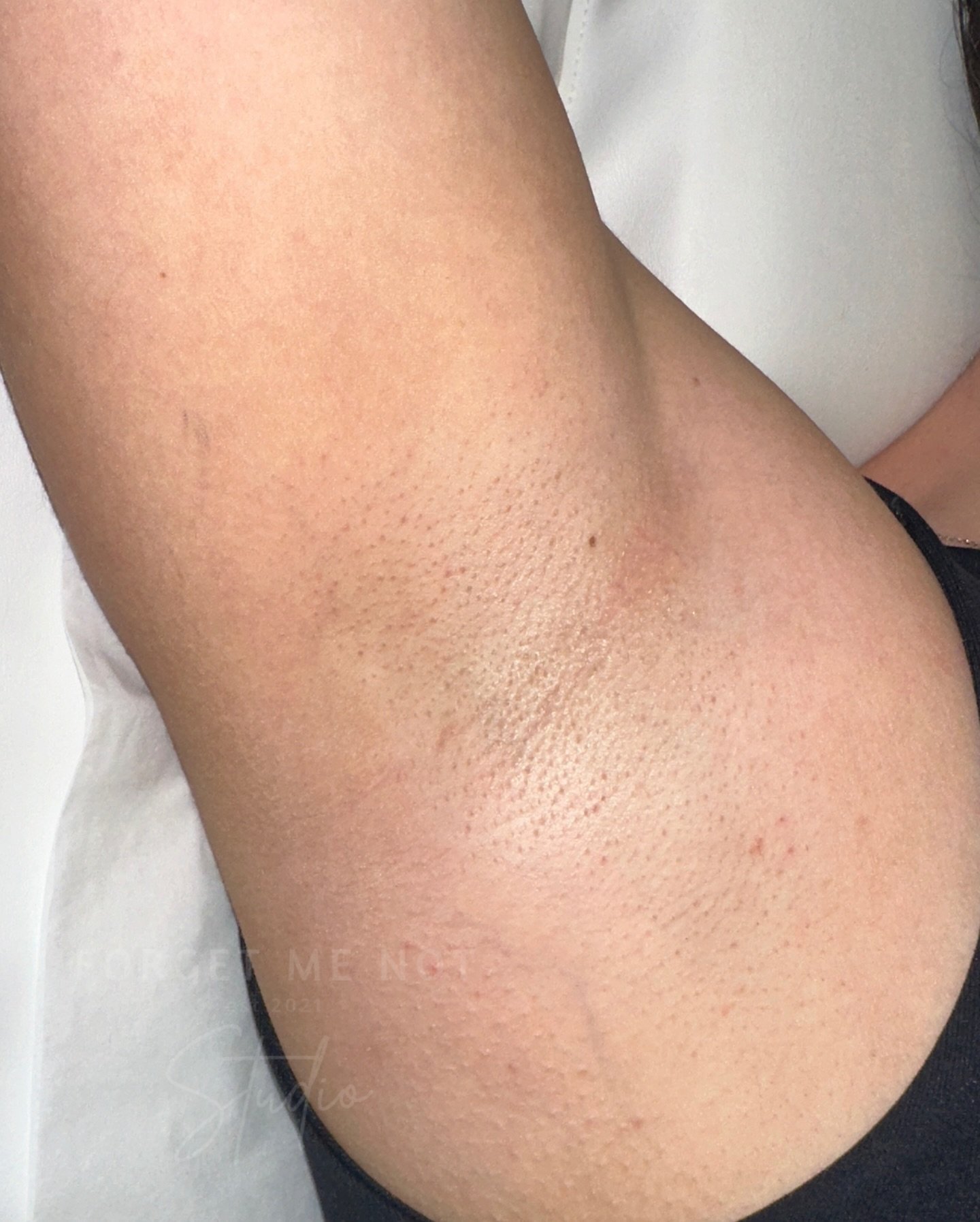 Obsessed with these laser hair removal results! ✨ Not only is my skin smoother, but it&rsquo;s glowing brighter than ever.

Book your consultation today! 🖥️ 

#LaserHairRemoval #SmoothSkin #laserhairremovalgloucestershire
#laserhairremovalcheltenham