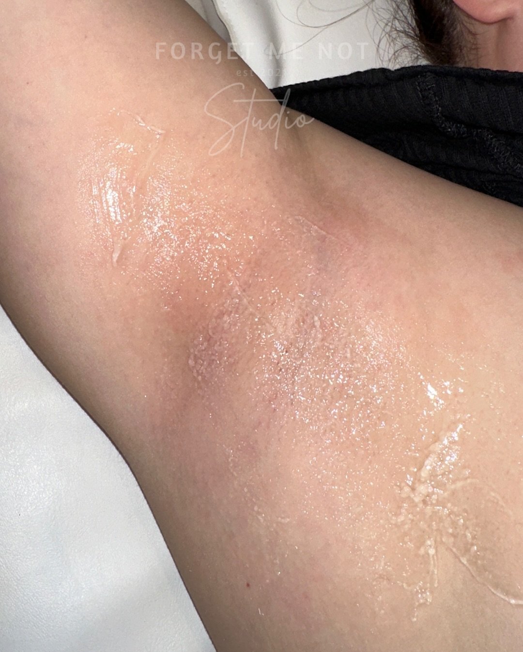 ✨ Incredible Underarm Laser Hair Removal Results! ✨

Check out these amazing before and after results! Our client shaved the night before on her before photo, but after a full course of laser hair removal, they haven&rsquo;t shaved for MONTHS&mdash;a