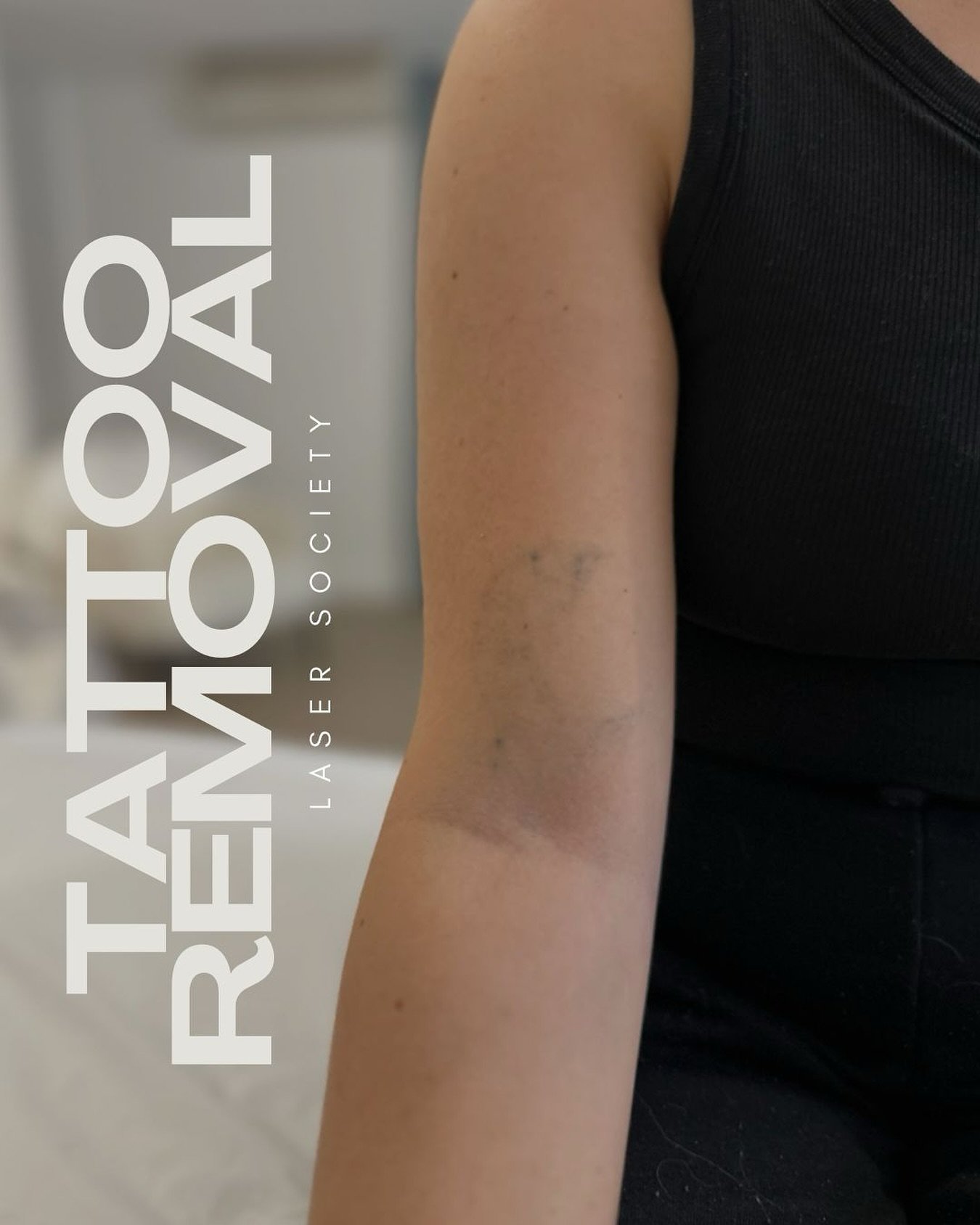 Ready to make a little &lsquo;oops&rsquo; disappear? 👋🏼

Our laser tattoo removal treatments are gentle, effective, and designed to fade the past - literally 🖤 

Say goodbye to ink regrets and hello to fresh skin! DM us to find out more. 

#lasert
