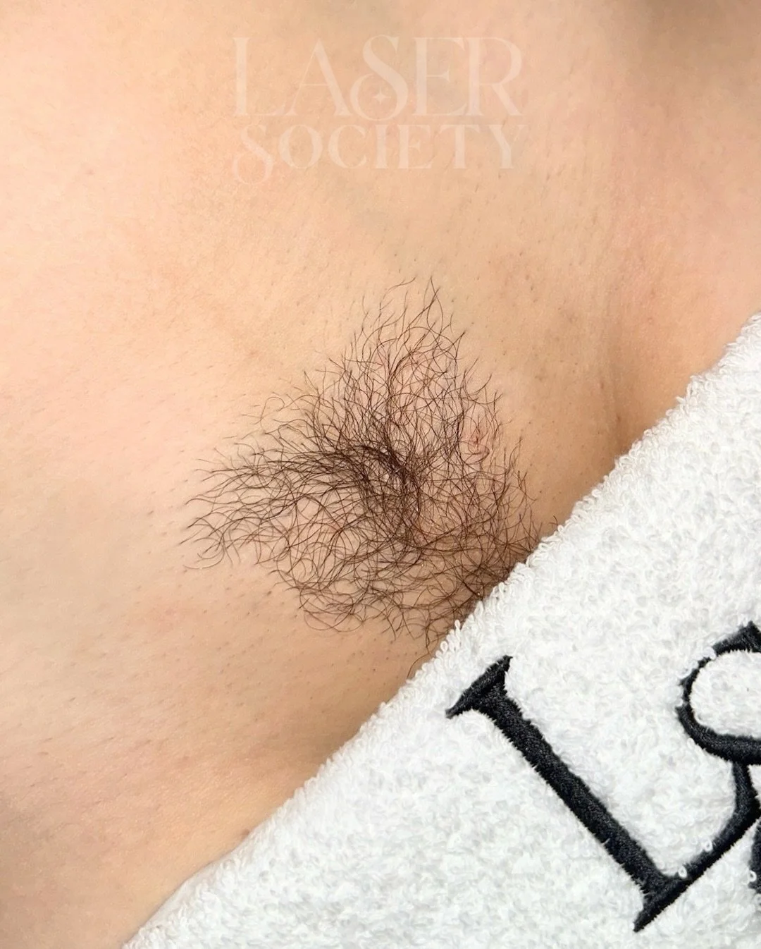 Nothing beats the confidence of real results! smoother skin ✨ fewer ingrowns 🚫 and a Brazilian that stays effortless for weeks.

Ready to start your own journey? Book a consultation today.
#laserhairremovalcheltenham #cheltenham #laserhairremoval