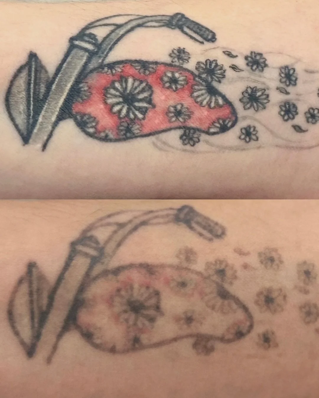 WORK IN PROGRESS&hellip; and WOW ✨
This is your reminder that laser tattoo removal is a journey &mdash; and the results speak for themselves 👀🔥

Every session breaks down more ink, allowing your body to naturally clear it over time ✨

Patience + co