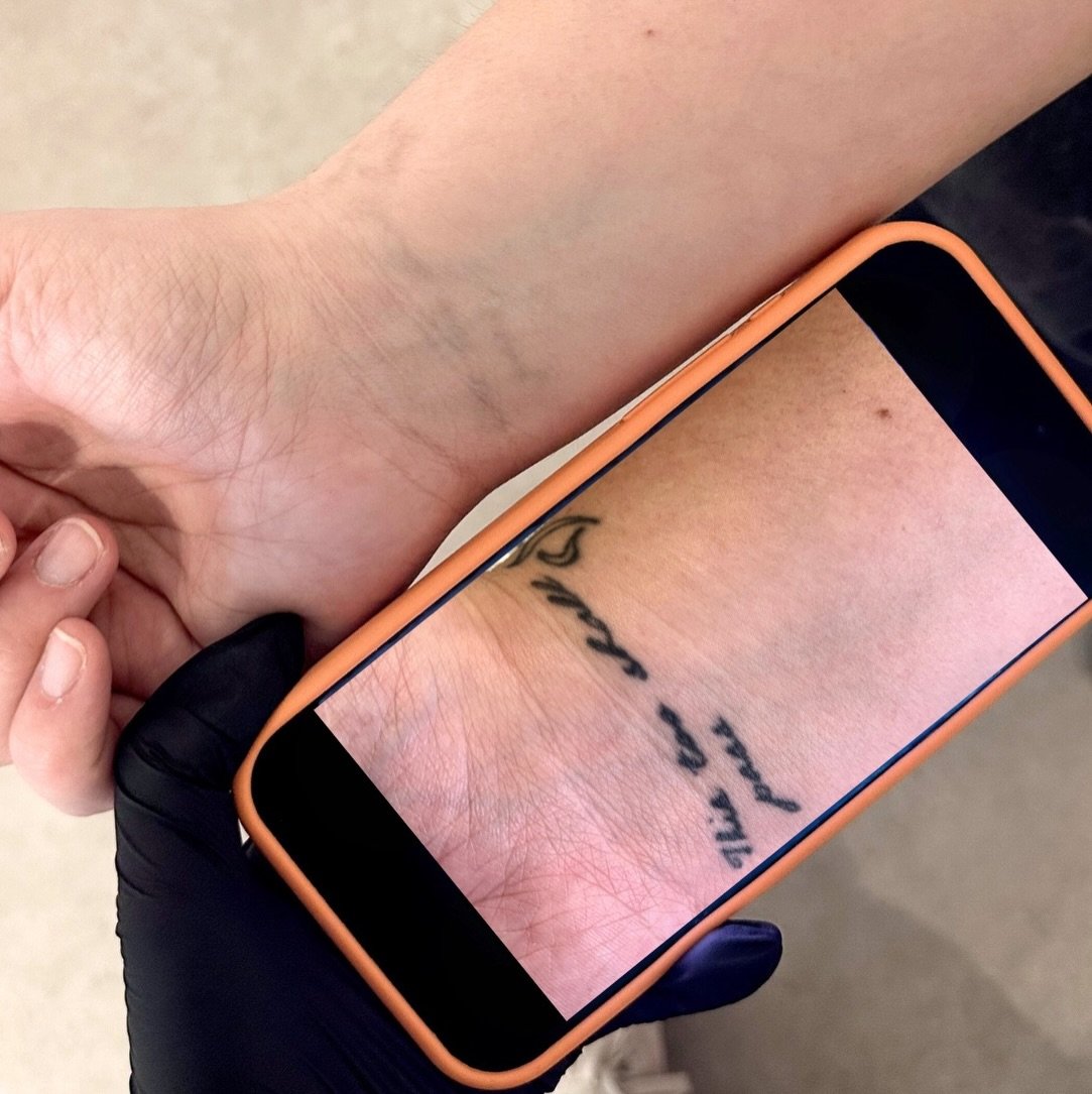 👀 One last session&hellip; then we wait.
This is what tattoo removal really looks like.
Ring: the very beginning 📱

Right: now &mdash; faded, broken down, and almost gone.
After just one final session, we&rsquo;ll reassess in 6+ months to let the b