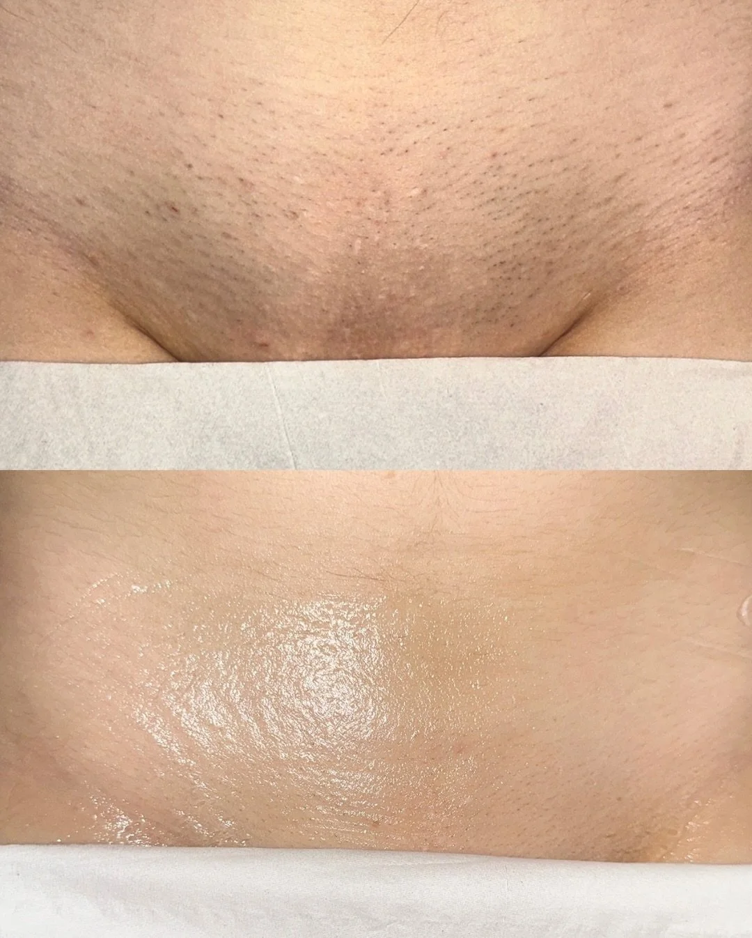 ✨ Still shaving? It&rsquo;s time to upgrade. ✨
Our Hollywood Laser Hair Removal at Laser Society UK delivers long-lasting smoothness &mdash; no more ingrowns, razor rash, or constant maintenance.

Benefits of Hollywood Laser Hair Removal:
&bull; Perm