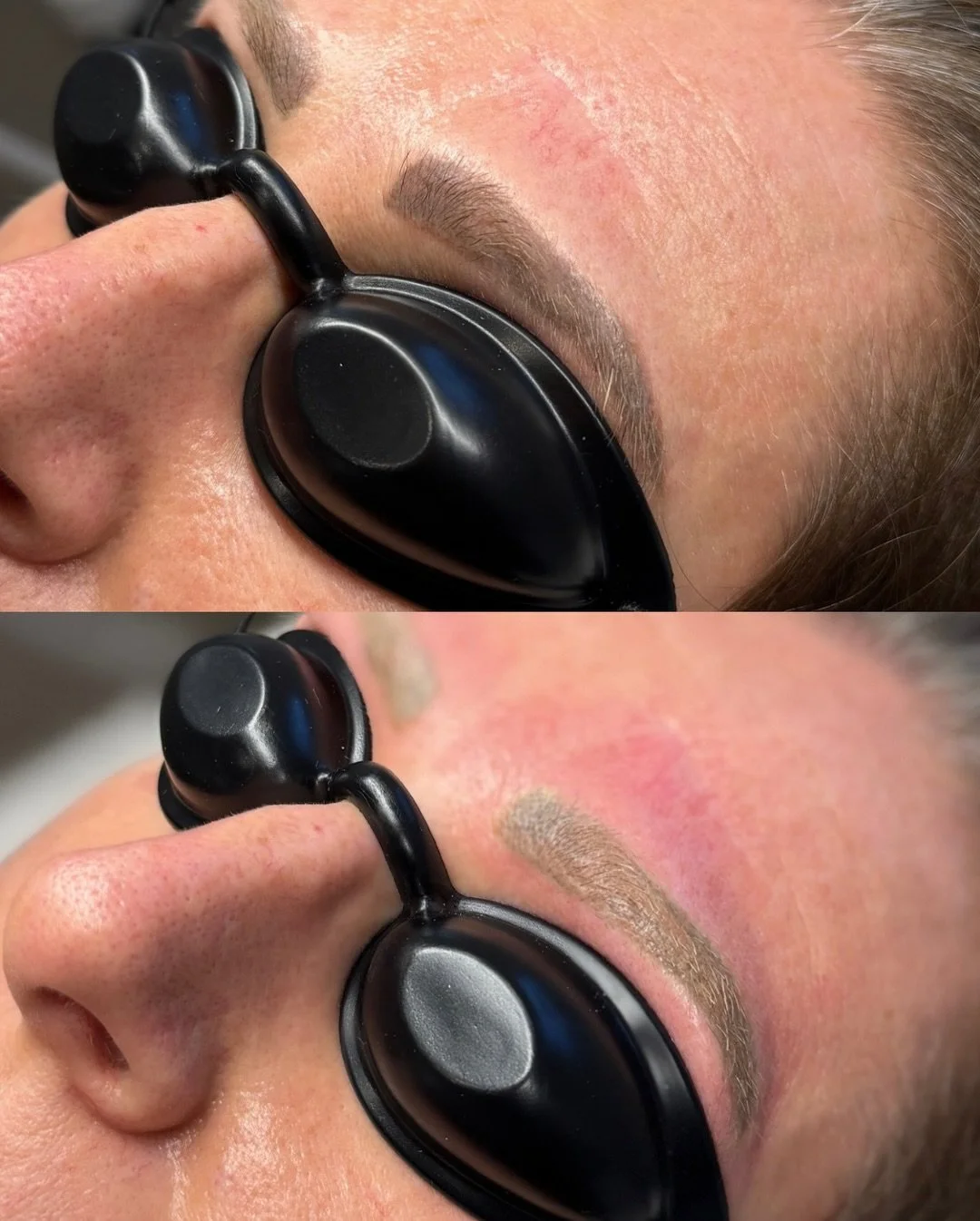 Did you know the more times brows are microbladed, the more pigment builds up in the skin?

This client has had her brows microbladed 8 times over the years. Each session deposits more pigment into the skin, which means removal can take a few session