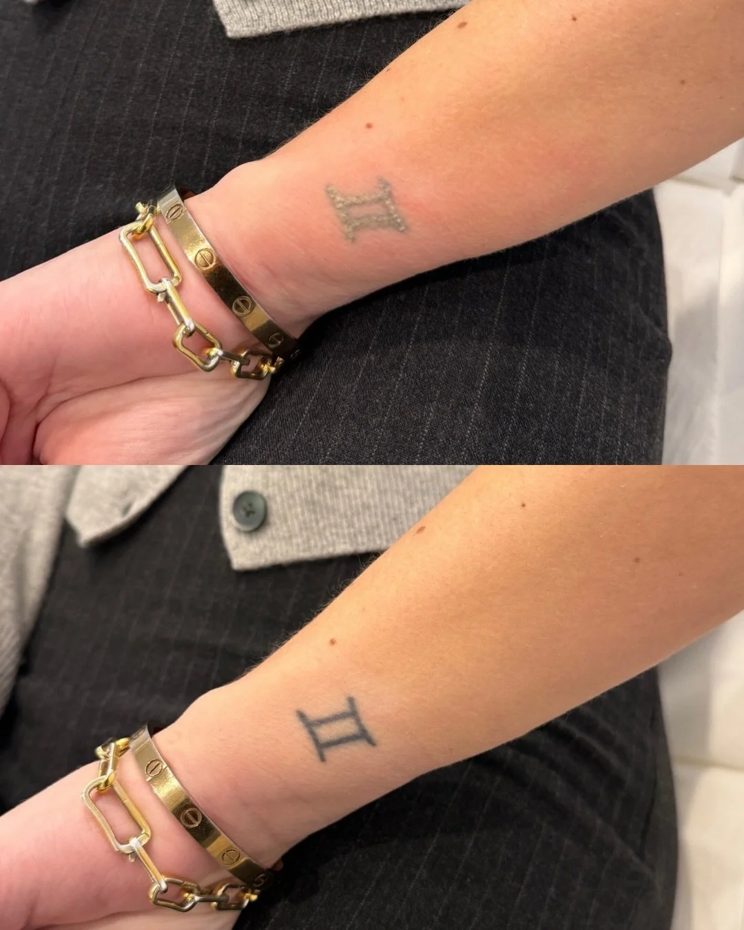 We love a first session frosting 👀✨

It&rsquo;s caused by tiny gas bubbles forming under the skins surface when the laser has hit the ink, it&rsquo;s temporary and only lasted 1-10 minutes🔥

If you&rsquo;ve been thinking about removing an old tatto