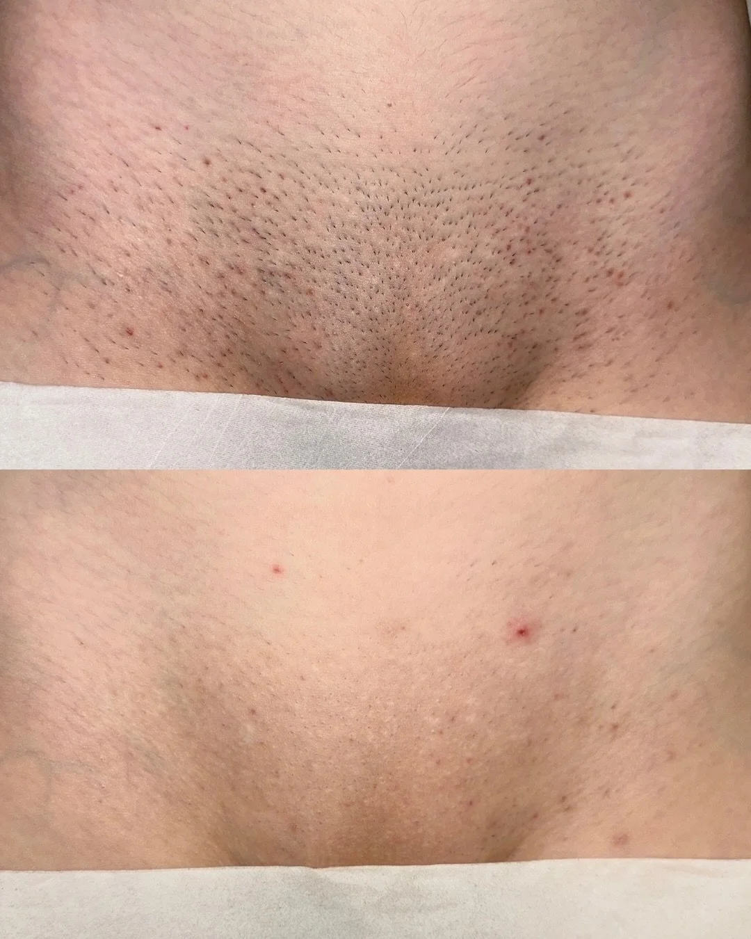 Still shaving every few days? Imagine the difference after just 4 sessions&hellip; 👀✨

This is what 4 sessions of Hollywood laser hair removal can achieve:
✔️ Significant hair reduction
✔️ Slower, finer regrowth
✔️ Smoother, irritation-free skin
✔️ 