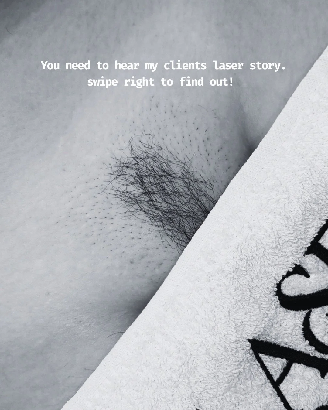 Imagine never worrying about shaving your bikini line again 👀✨

Razor burn, ingrown hairs, constant regrowth&hellip; sound familiar?
Laser hair removal is the upgrade your routine&rsquo;s been waiting for. It targets the hair at the root, helping to
