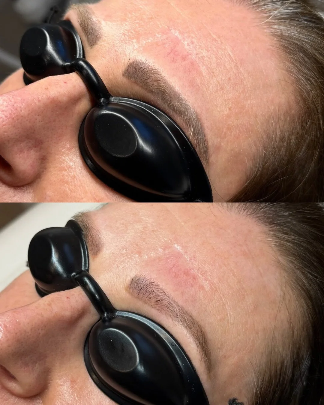 One session&hellip; and this is the difference 👀✨

Brow tattoo removal after just one session&mdash;and the fade is already doing its thing 🙌

Brows can typically take anywhere from 1&ndash;3 sessions for full removal, depending on the pigment, dep