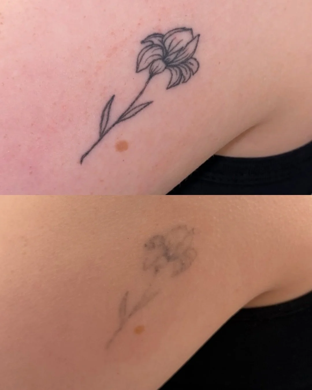 Still on the journey to clear skin? This is your sign to trust the process.
Swipe to see this tattoo removal transformation in progress 👀

Every session gets us one step closer to a clean fade and fresh start. Results take time, consistency, and the
