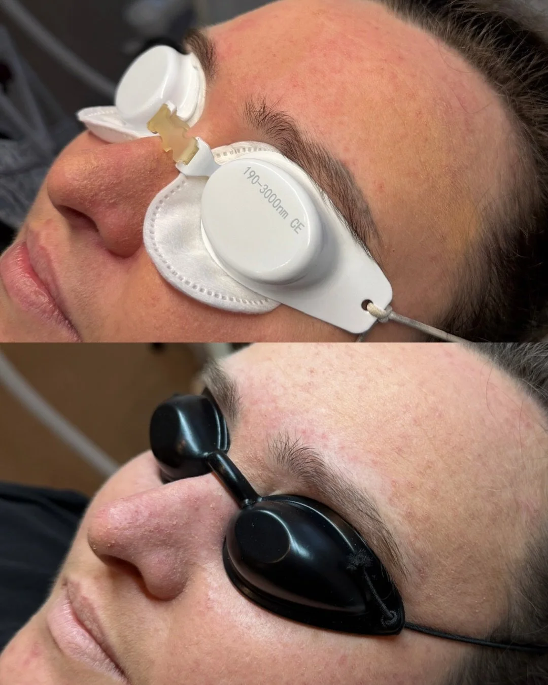 Microblading removal using laser tattoo removal 👀

Over time, microblading can fade into unwanted tones like grey, blue, red or orange &mdash; and that&rsquo;s where laser removal can help. The laser targets the pigment in the skin, breaking it down