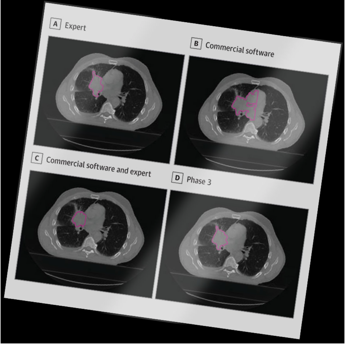 Deep learning algorithm can support radiation oncology