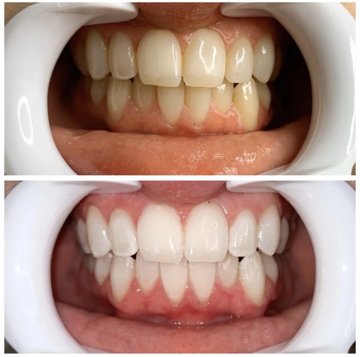 TeethWhitening.jpeg