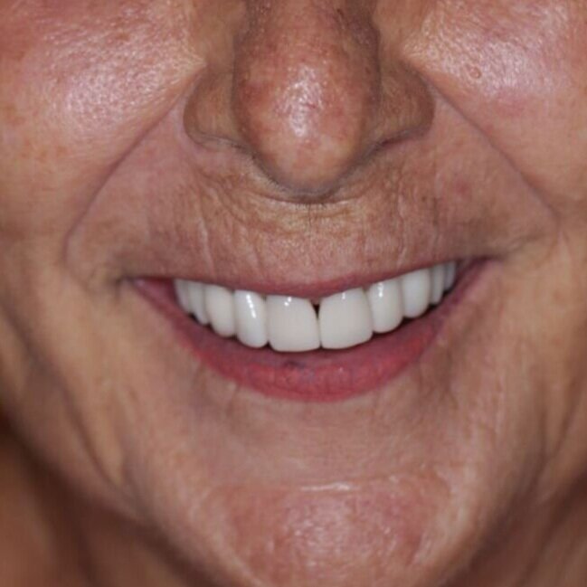 Carillas Dentales Costa Rica - Sonrisa Para Todos