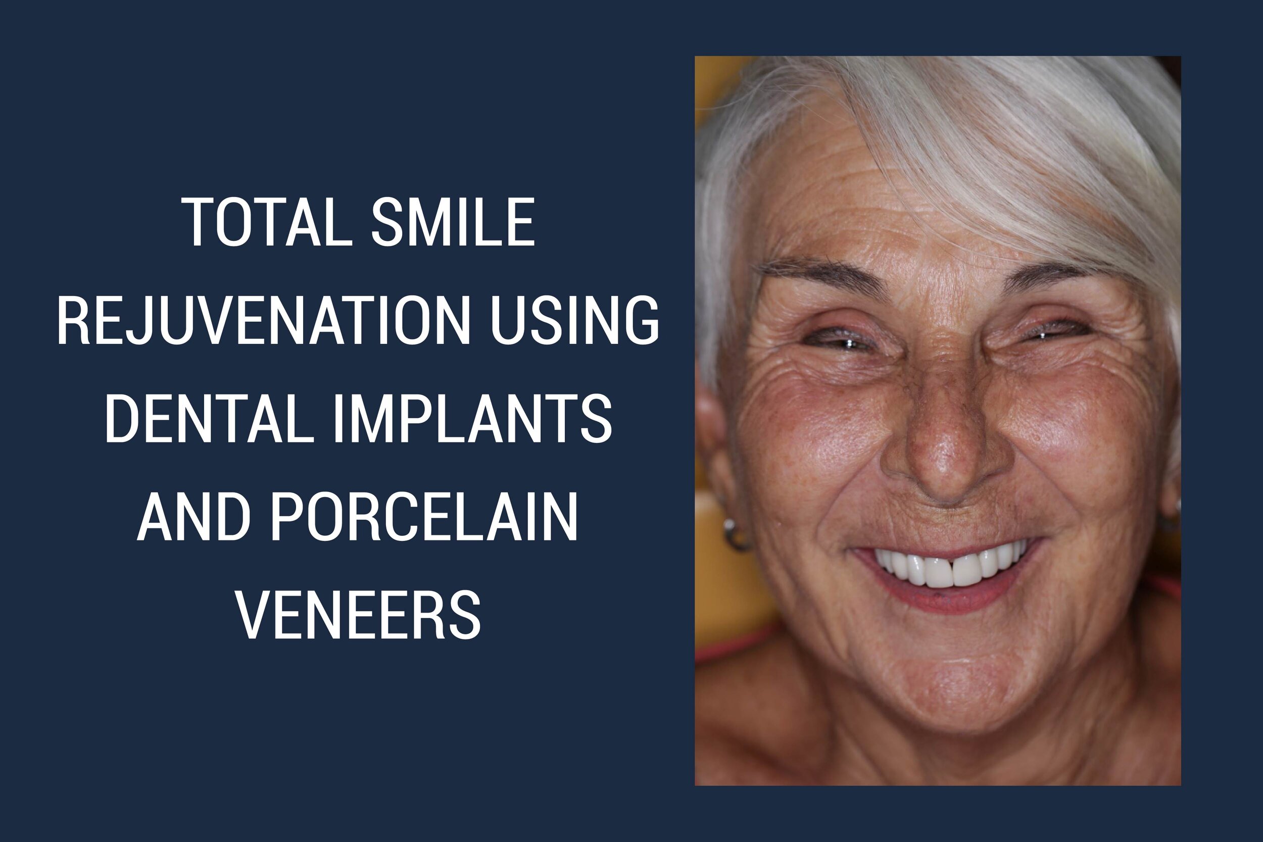 TOTAL  SMILE REJUVENATION USING DENTAL IMPLANTS AND PORCELAIN VENEERS