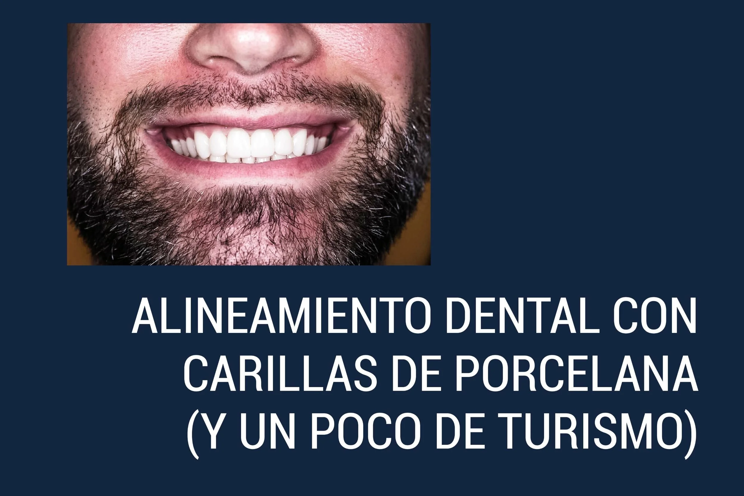 ALINEAMIENTO DENTAL CON CARILLAS DE PORCELANA (Y UN POCO DE TURISMO)