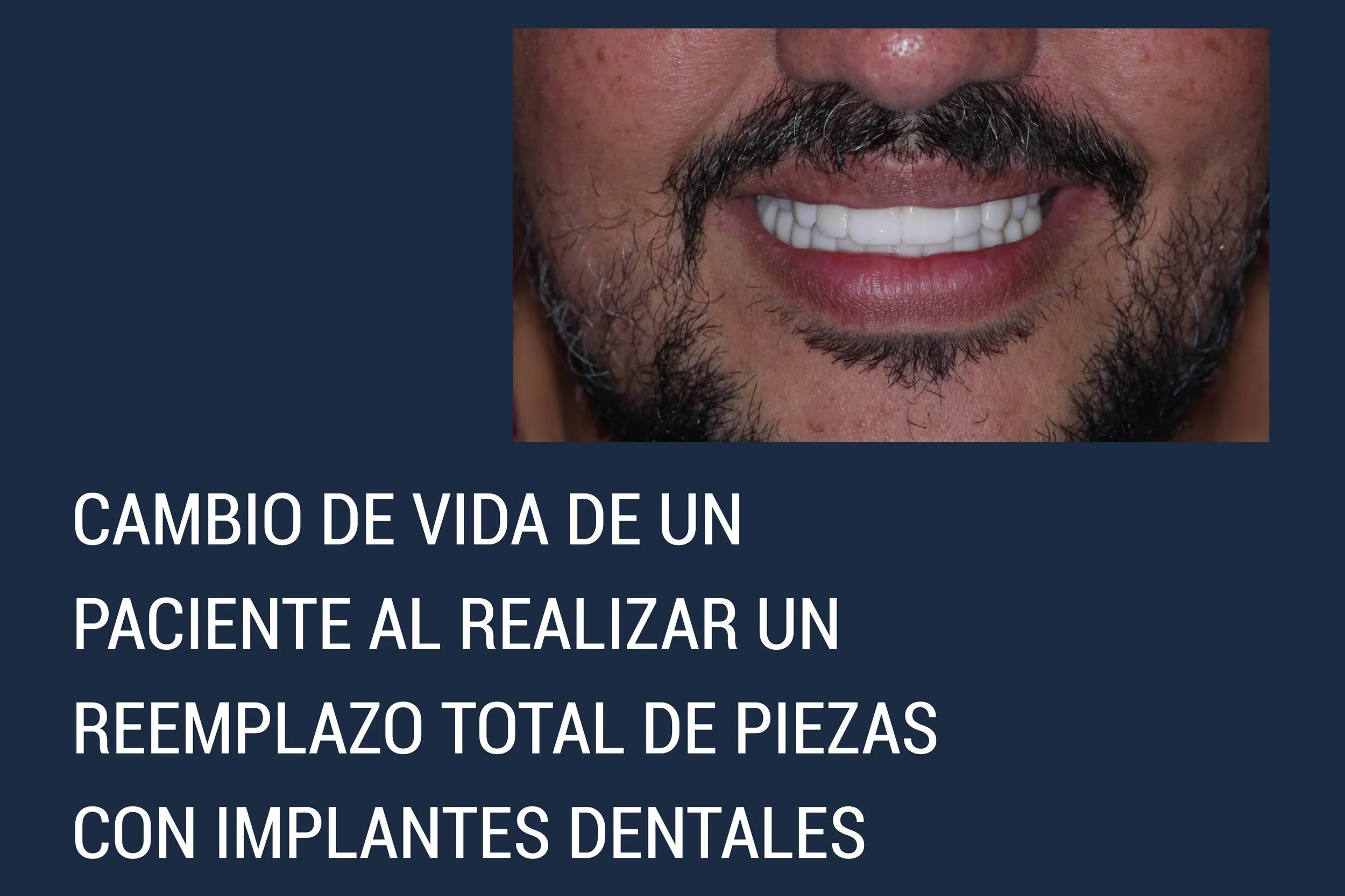 CAMBIO DE VIDA DE UN PACIENTE AL REALIZAR UN REEMPLAZO TOTAL DE PIEZAS CON IMPLANTES DENTALES