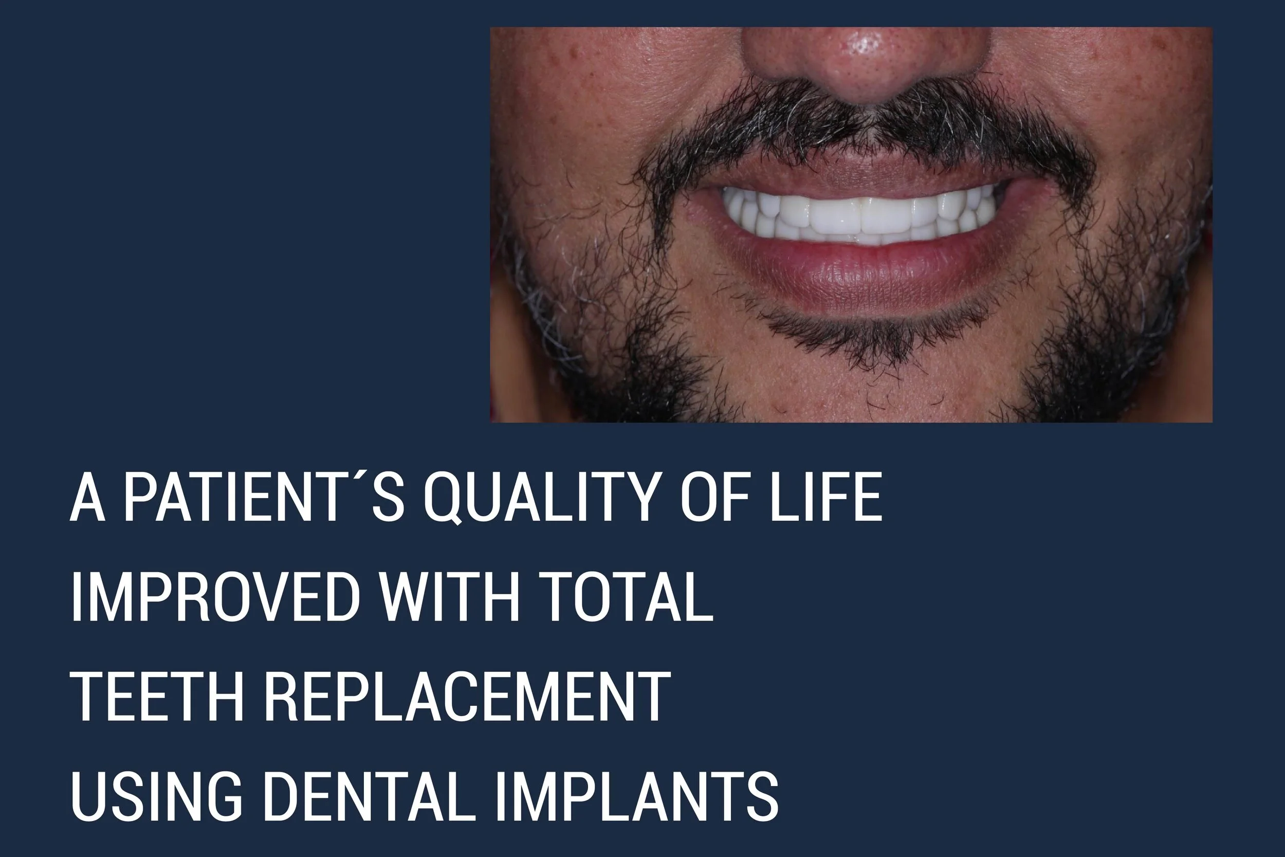 A PATIENT´S QUALITY OF LIFE IMPROVED WITH TOTAL TEETH REPLACEMENT USING DENTAL IMPLANTS