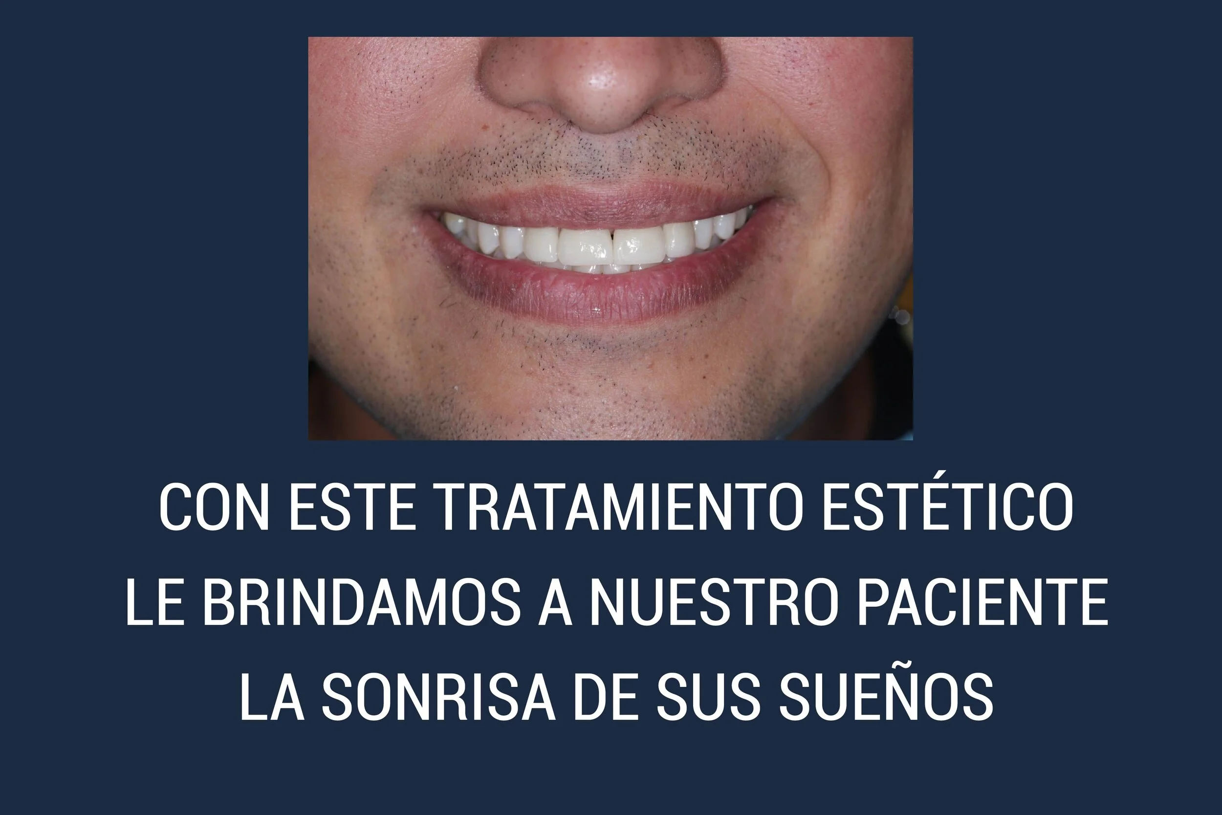 CON ESTE TRATAMIENTO ESTÉTICO  LE BRINDAMOS A NUESTRO PACIENTE  LA SONRISA DE SUS SUEÑOS