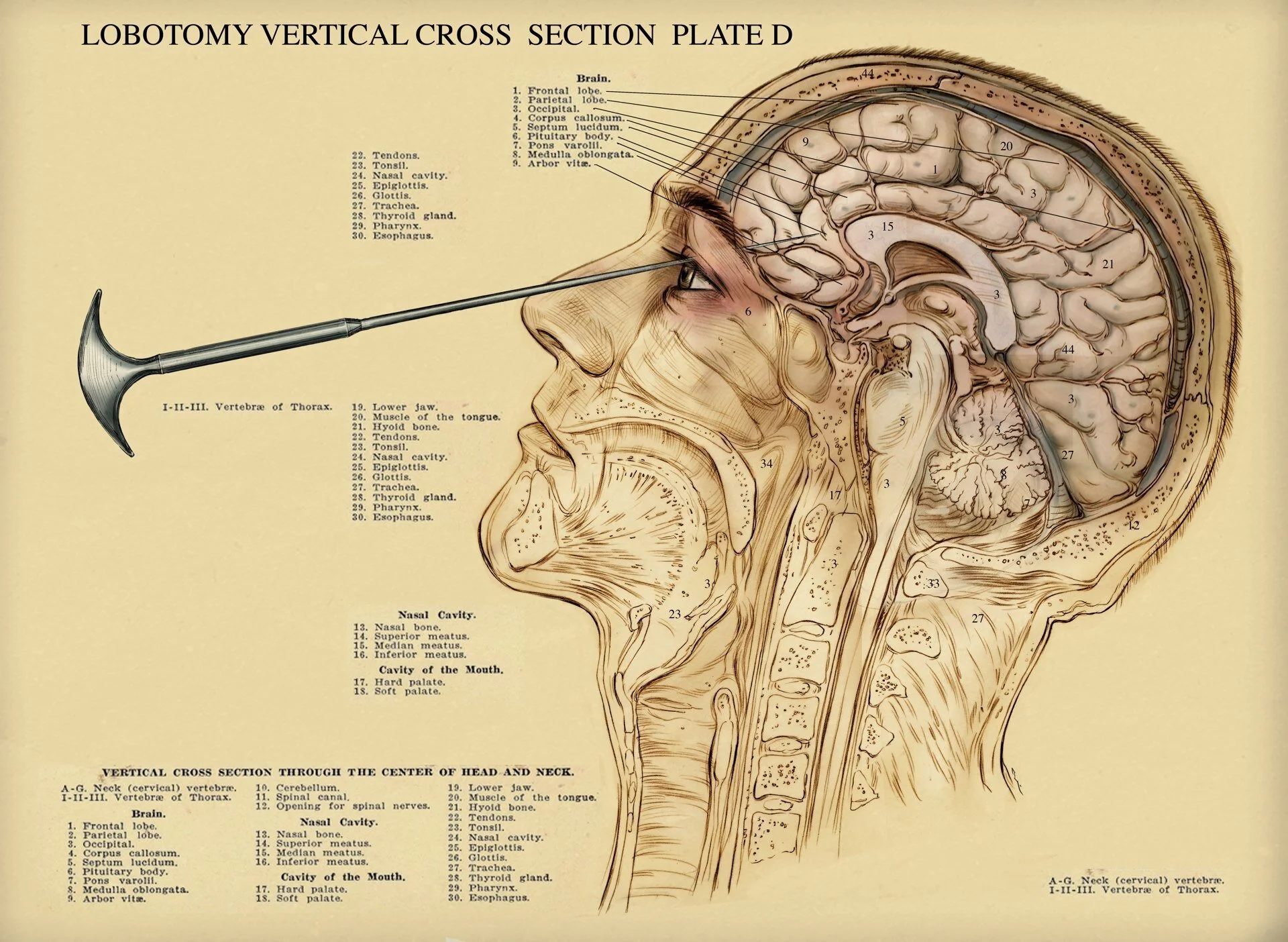 lobotomy_line_rev3_flt.jpg
