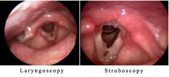 laryngoscopy vs strobe.jpg