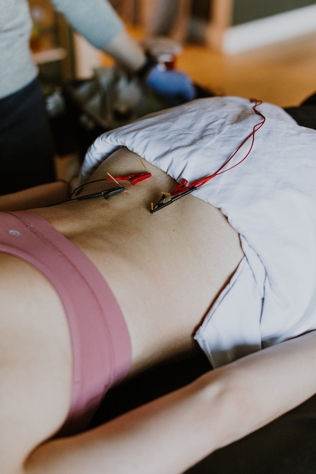 Dry Needling + Pelvic Heath: A less invasive approach