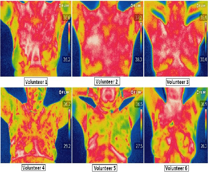 Breast Thermography: What You Need to Know