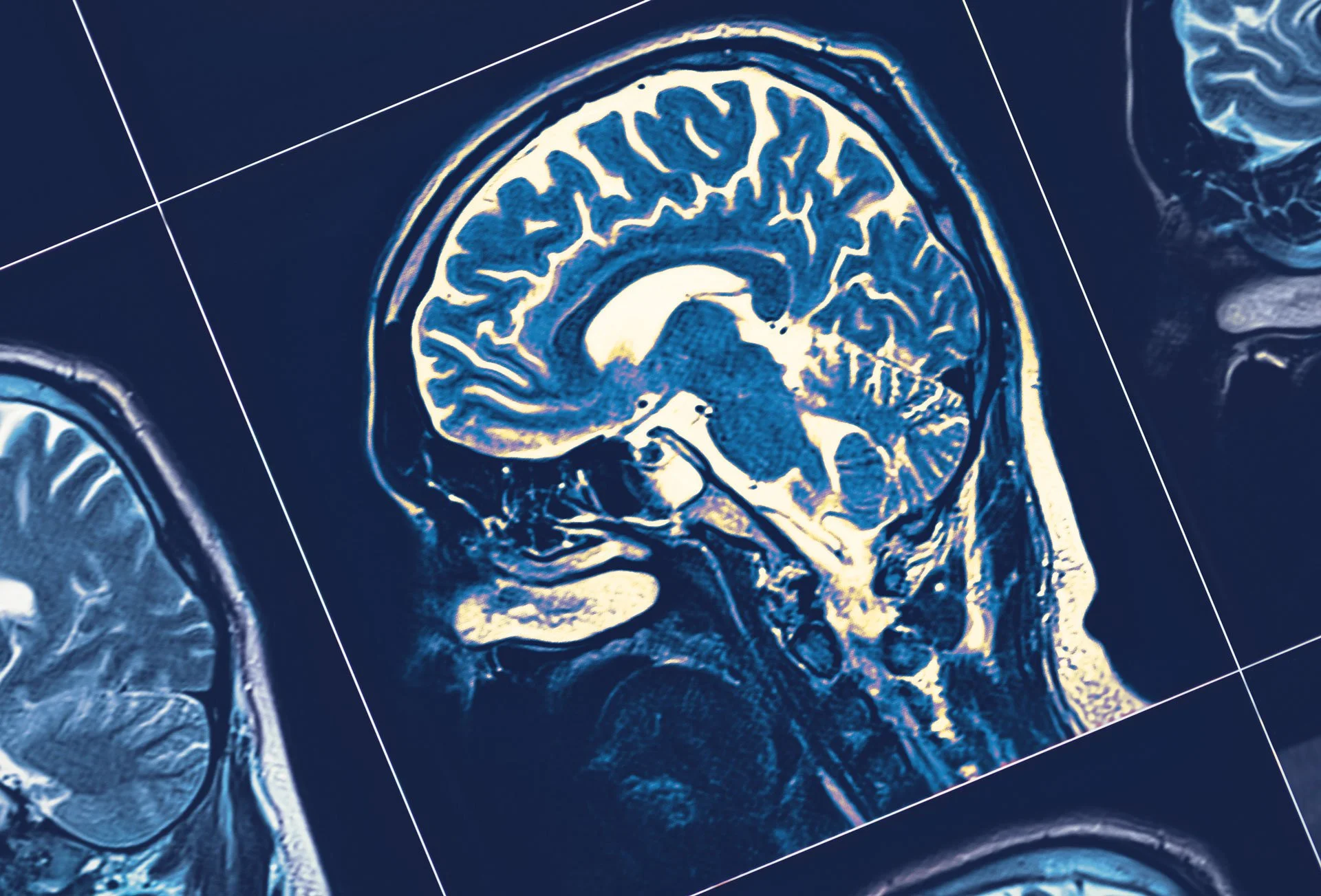 Is There a Relationship Between Sleep Apnea and Dementia?
