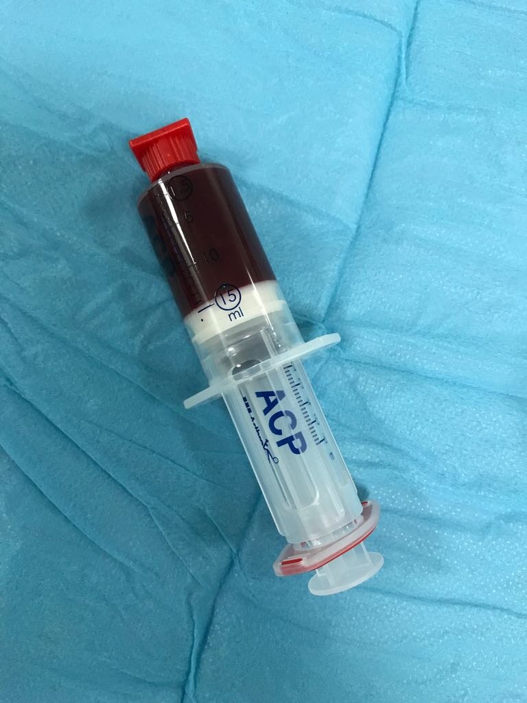 1. Whole Blood for PRP