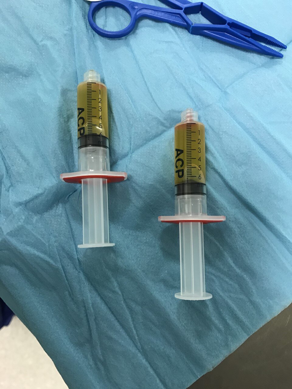 5. Platelet Rich Plasma Ready For Injection