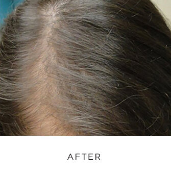 PRP Hair Loss Restoration — Swoon Aesthetic Spa & Acne Clinic