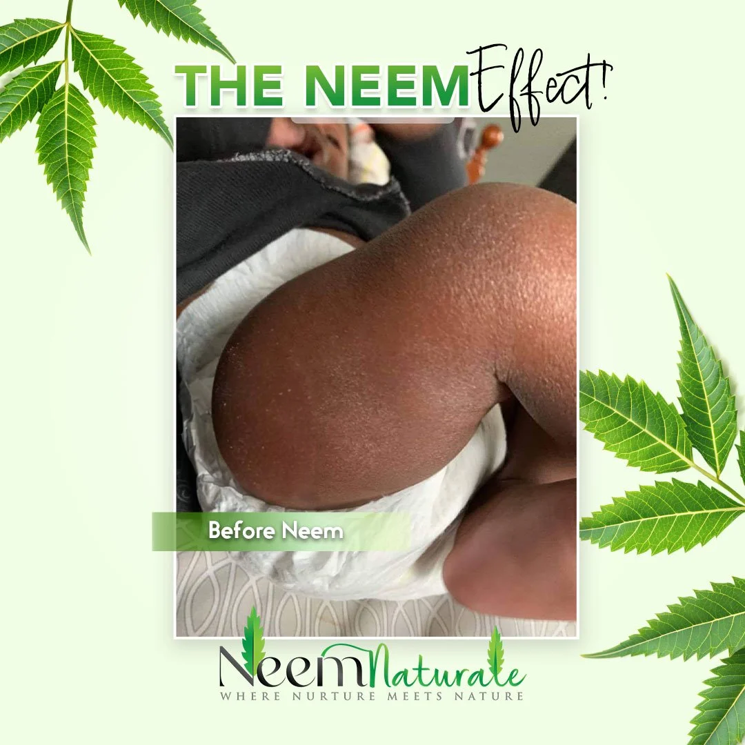 Real People. Neem Results! 
Try our Moisturizing Body Balm for:
🍃Dry Skin
🍃Eczema 
🍃Itchy Skin
🍃Psoriasis 
🍃Acne

Order Yours Today!
www.neemnaturale.co

#NeemNaturale #acne #skincare #psoriasis
