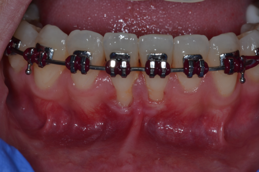 Before