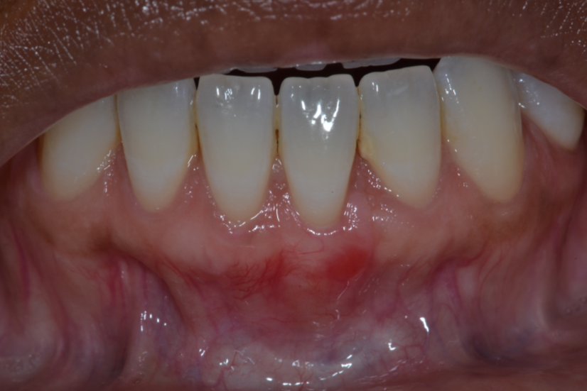 After Connective Tissue Graft