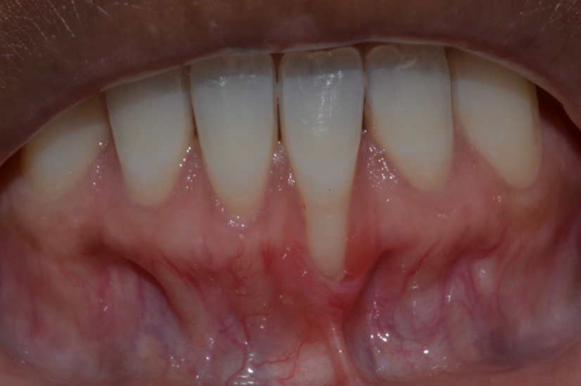 Gum Recession Before