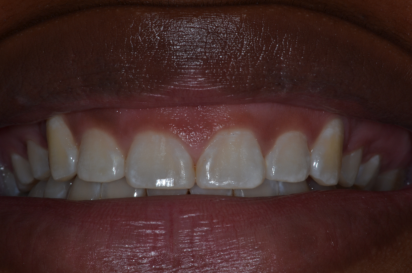 "Gummy" Smile Before