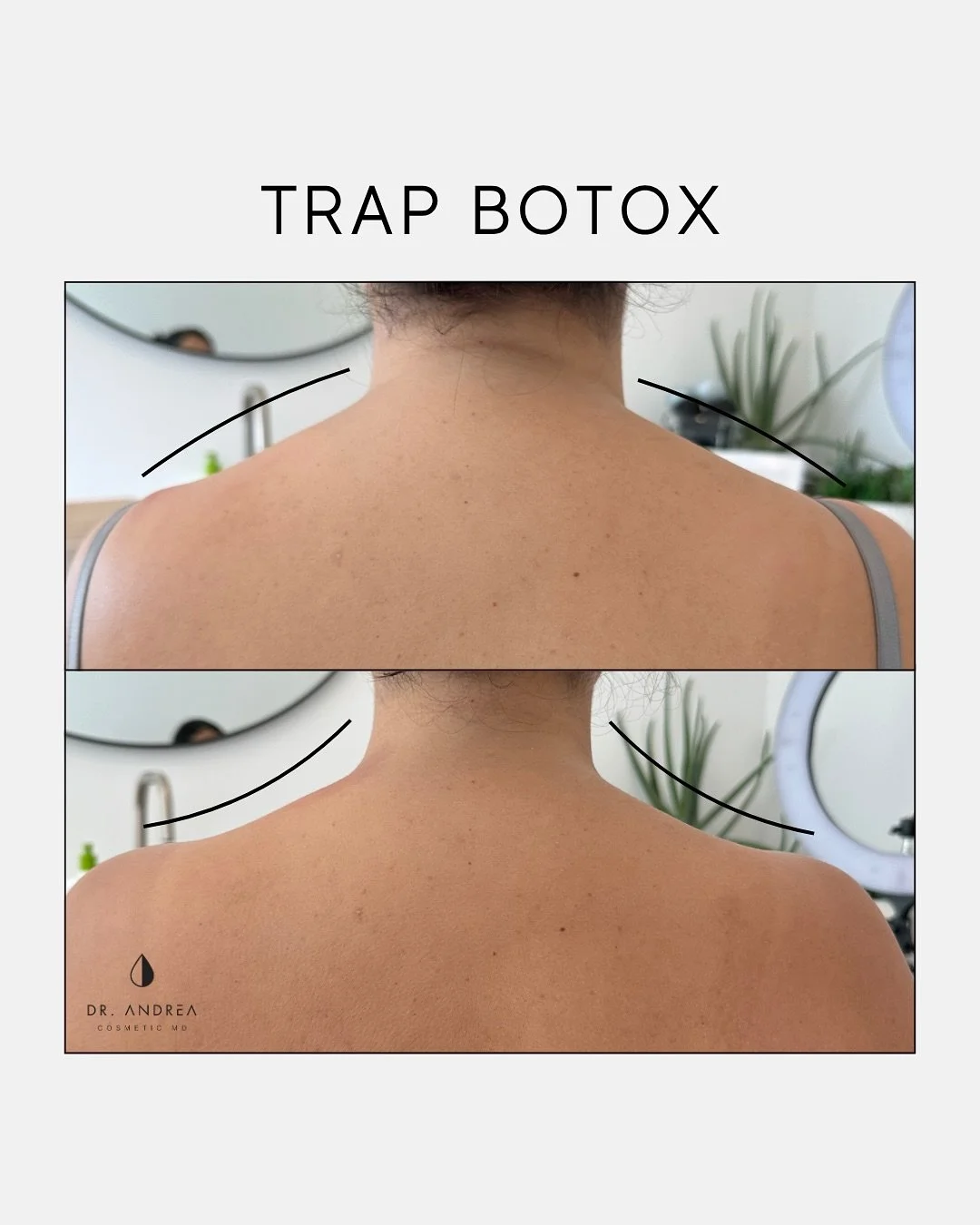 If you carry tension in your upper neck and shoulders, and massages are not enough, trapezius (trap) Botox may offer relief. By relaxing the top portion of the trapezius muscles, this treatment can ease built-up tension, reduce discomfort, and even i