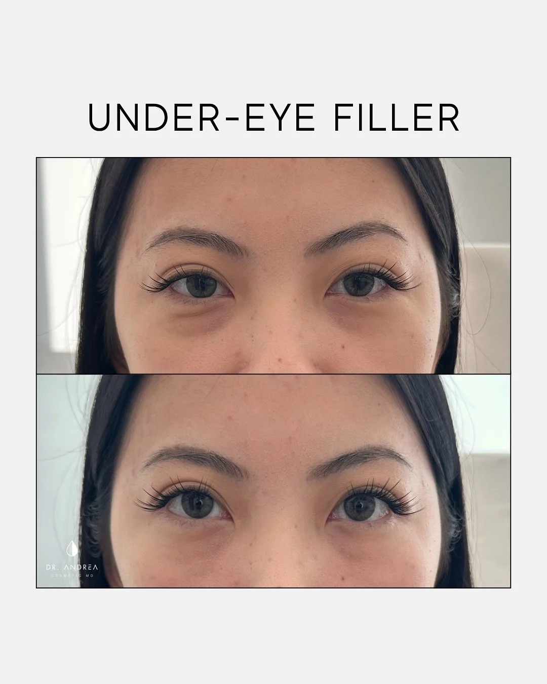 This patient had fat removed from her under-eye area 6 years ago, which led to progressive hollowing over time. Under-eye filler was used to carefully replace lost volume and bring back a refreshed, more balanced look.

My signature READY-SET-GO micr