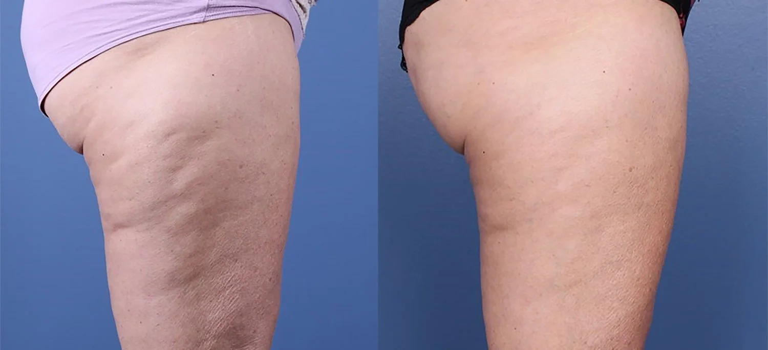 morpheus8-before-after-dr-s-obaid-preview-2.jpg