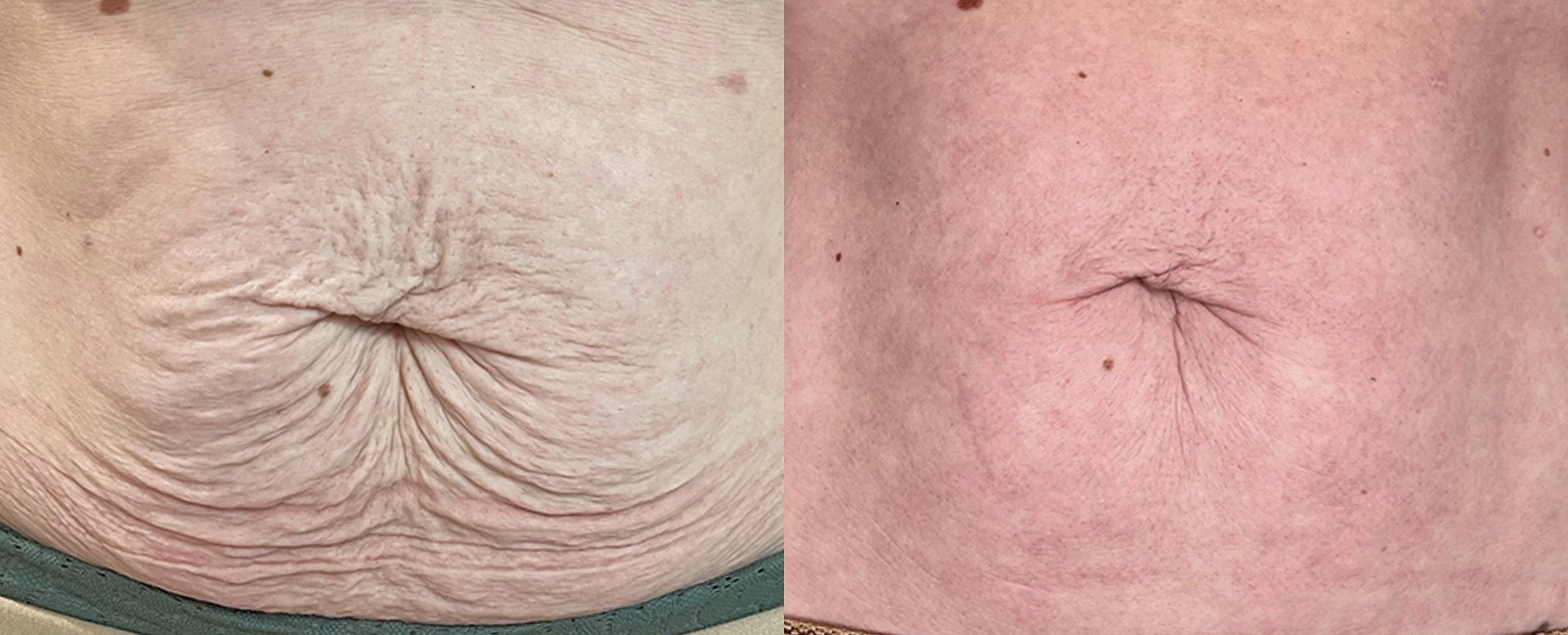 NB_M8B_Before_After_24Weeks_Abd_Zoomed-TM.jpg