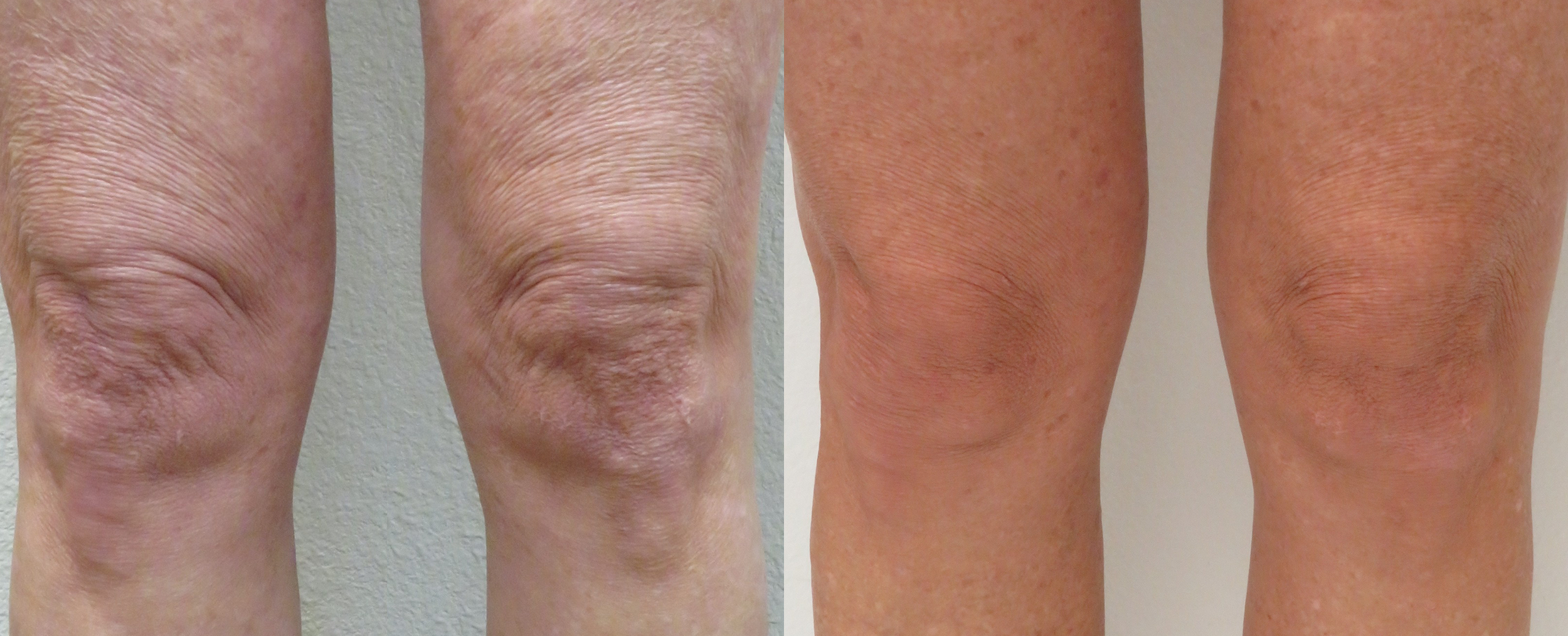 morpheus8-before-after-premier-med-spa-of-lufkin-preview-1.png