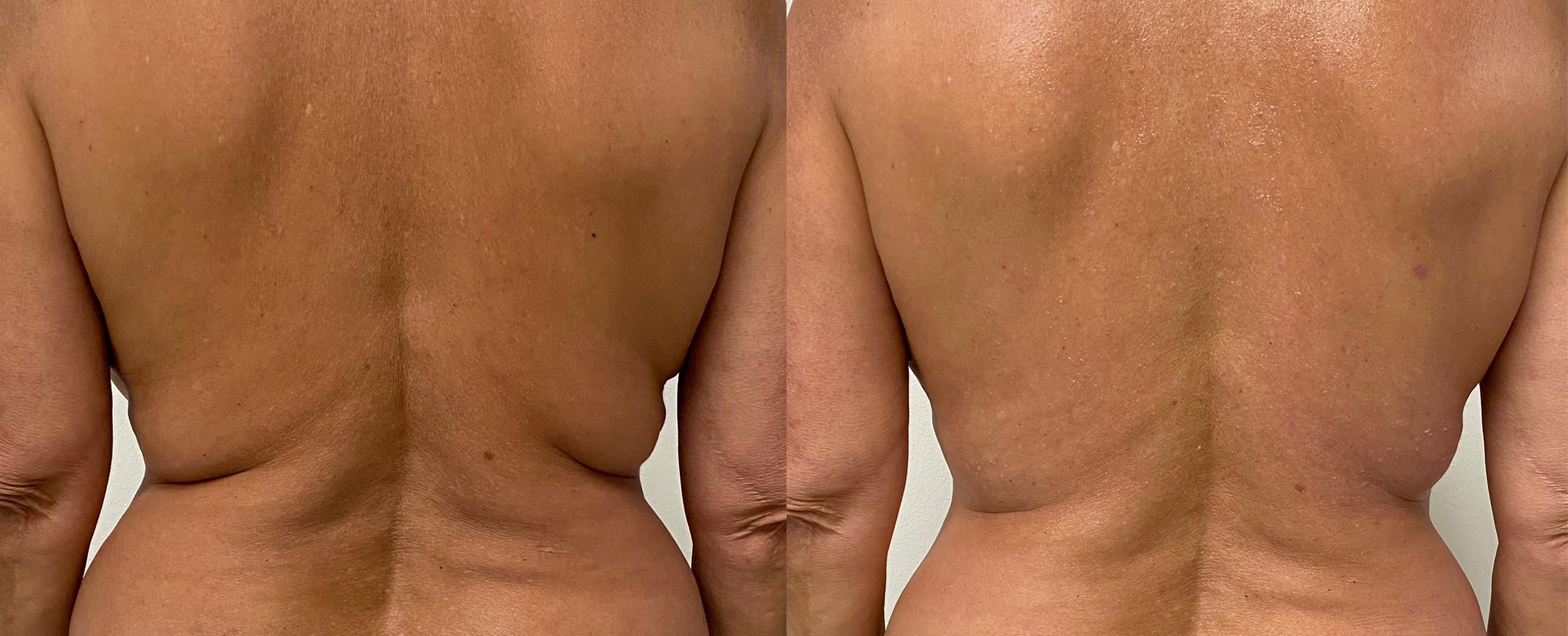 morpheus8-body-before-after-novo-medspa-preview-1.png