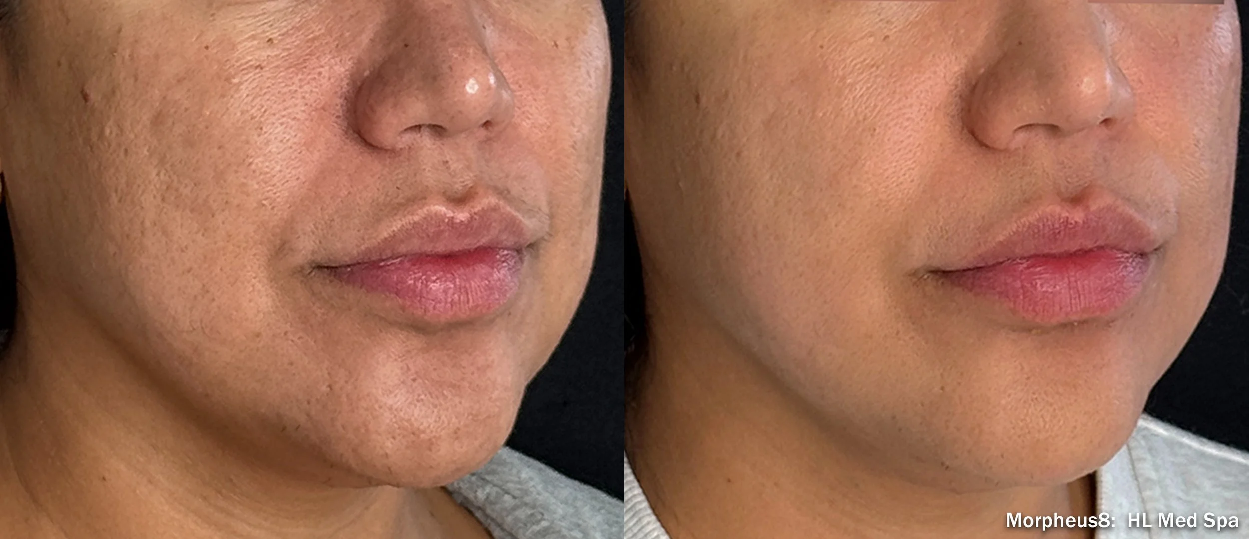 HL_Med_Spa_M8_Face_RS_Angl-TM.jpg