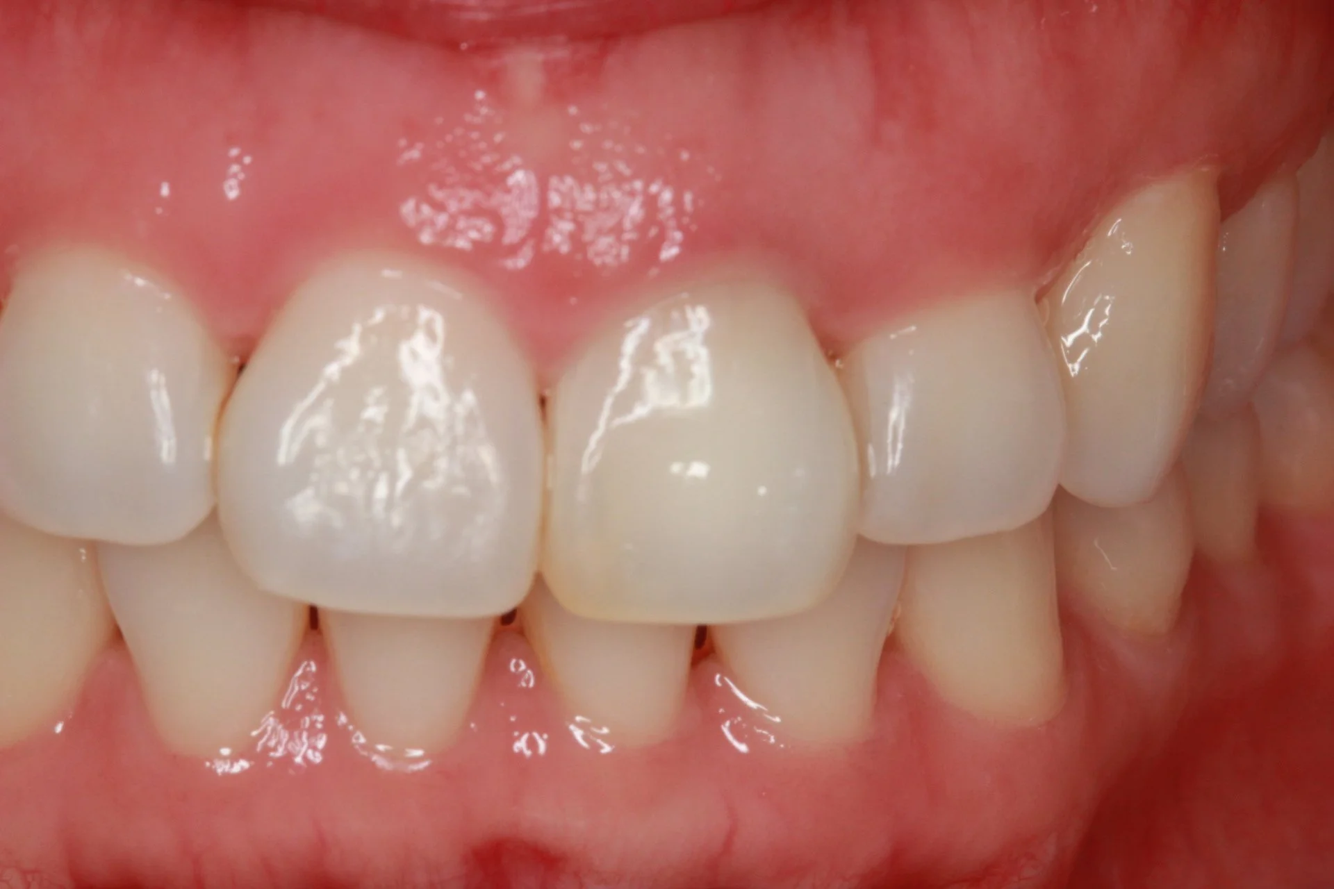 After treatment, showing the same front tooth closer in shade to the neighbouring teeth.