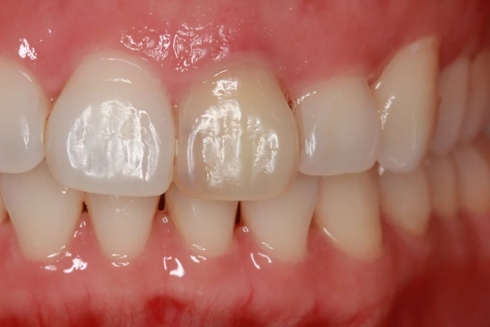 Before internal bleaching, showing one upper front tooth darker than the neighbouring teeth.