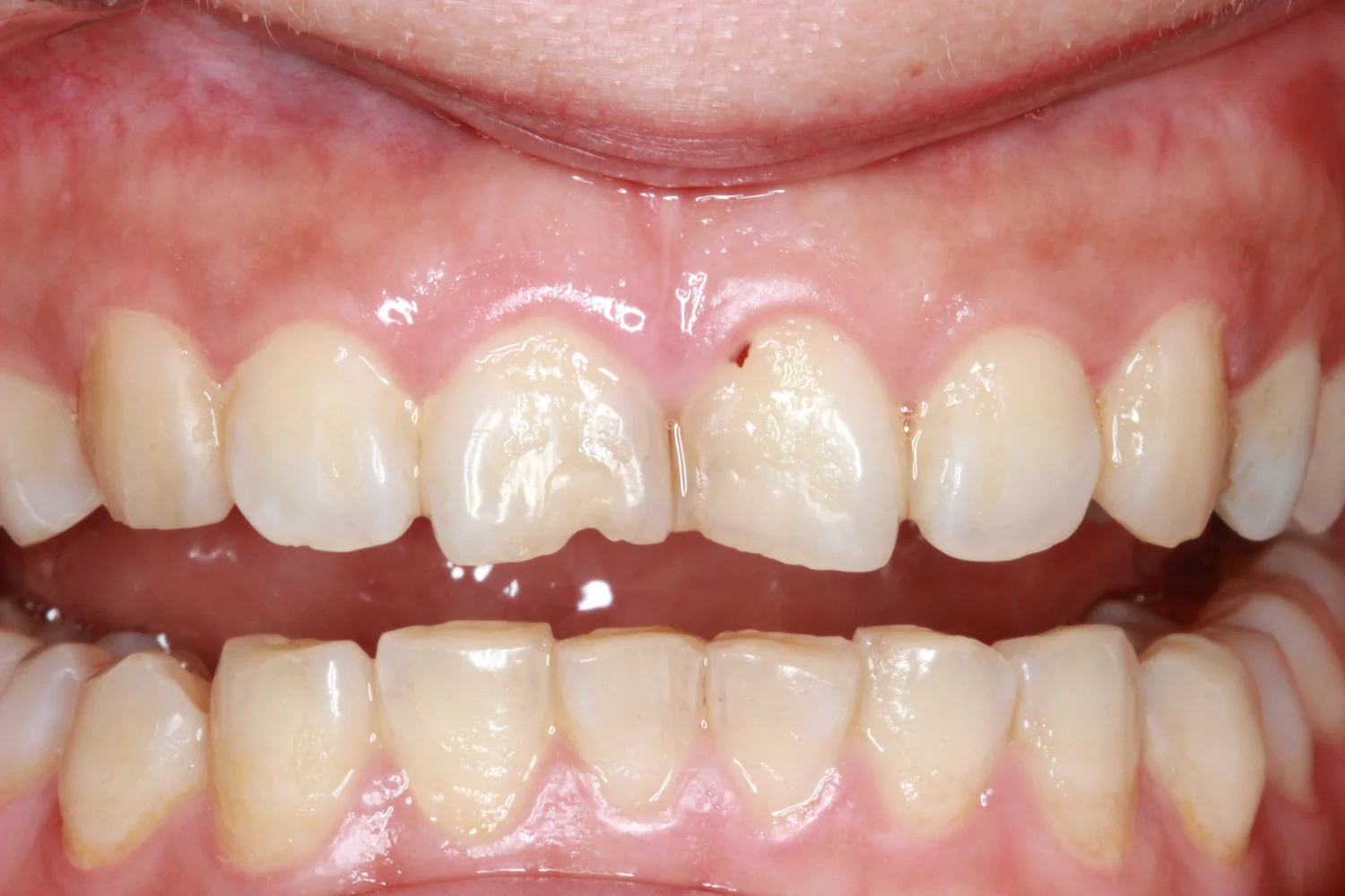 Upper front teeth before composite restoration, showing small irregularities along the biting edges.