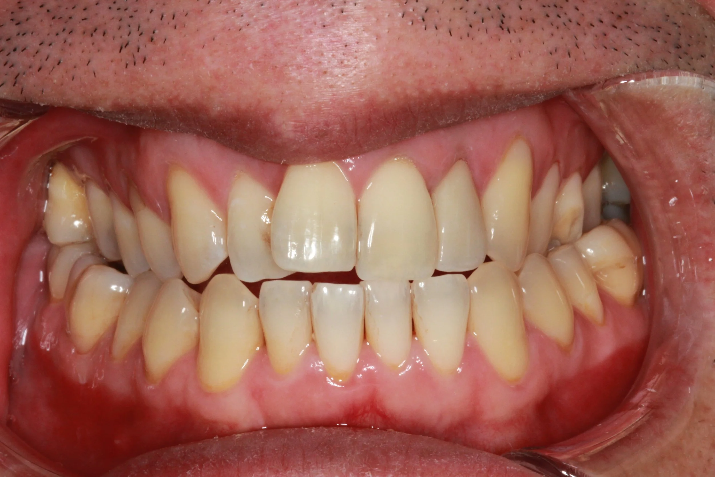 The same upper front tooth after a dental crown was fitted, shown beside the neighbouring teeth.